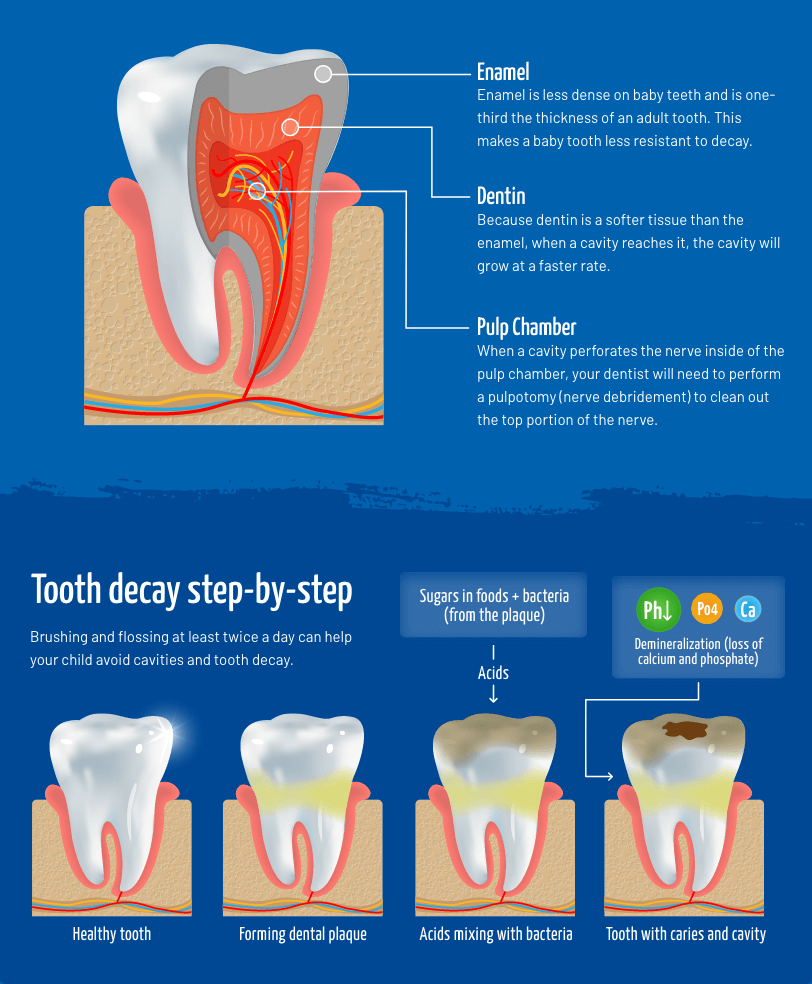 Tooth Decay Infographic